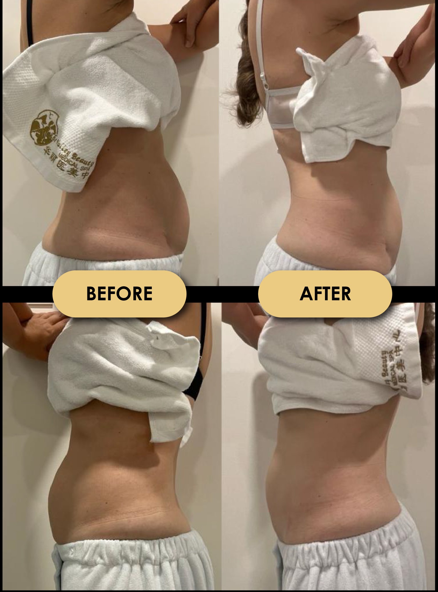 Body Sculpting — Before & After 1 · The Valley, Kuala Lumpur