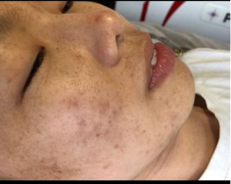 Cell Light Therapy — Before & After 1 · The Valley, Kuala Lumpur