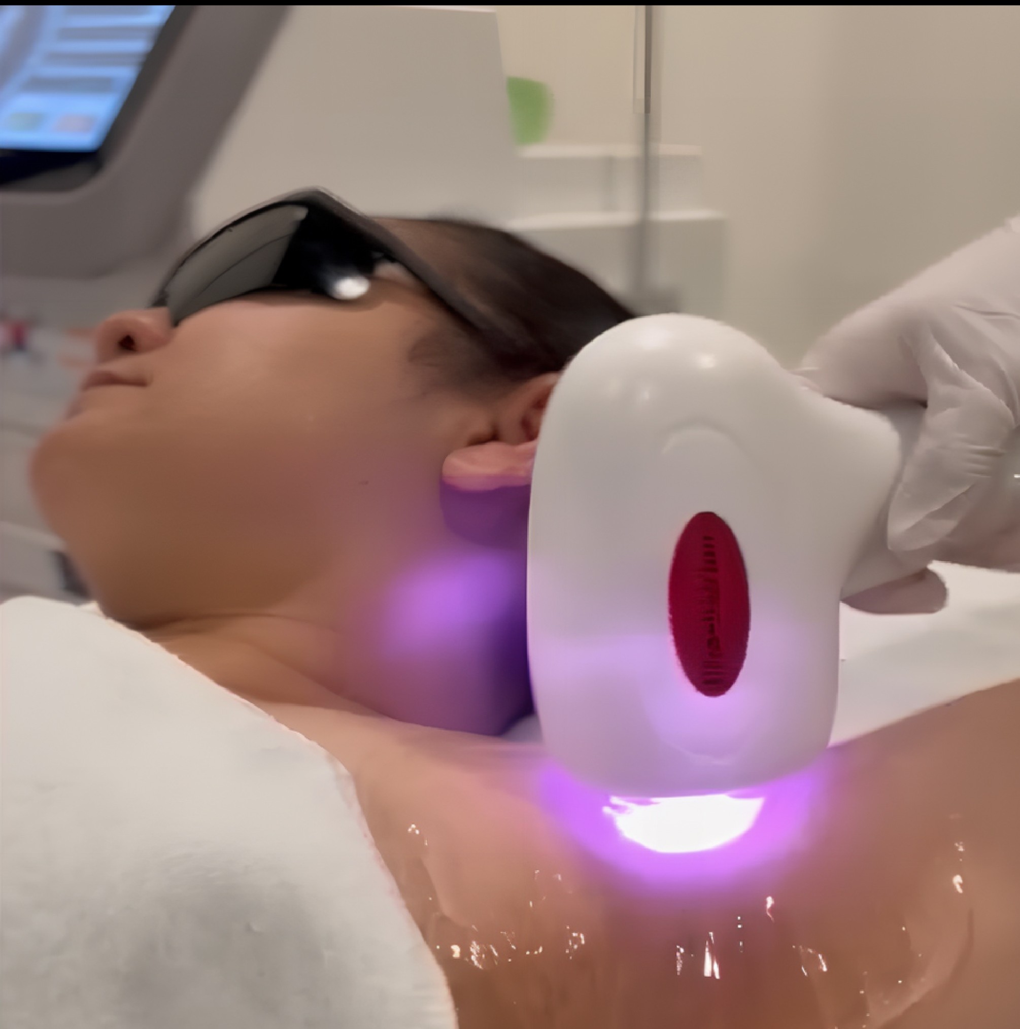 Hair Removal — Before & After 1 · The Valley, Kuala Lumpur