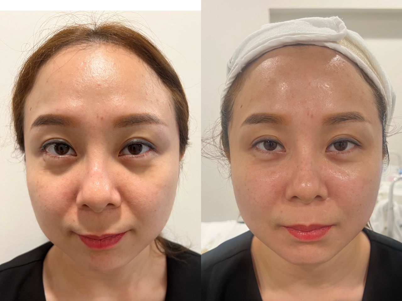 HIFU Lifting — Before & After 1 · The Valley, Kuala Lumpur