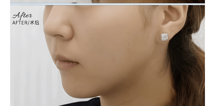Pico Laser — Before & After 2 · The Valley, Kuala Lumpur