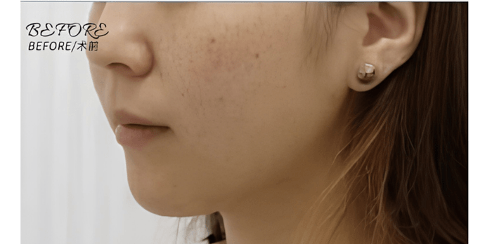 Pico Laser — Before & After 1 · The Valley, Kuala Lumpur