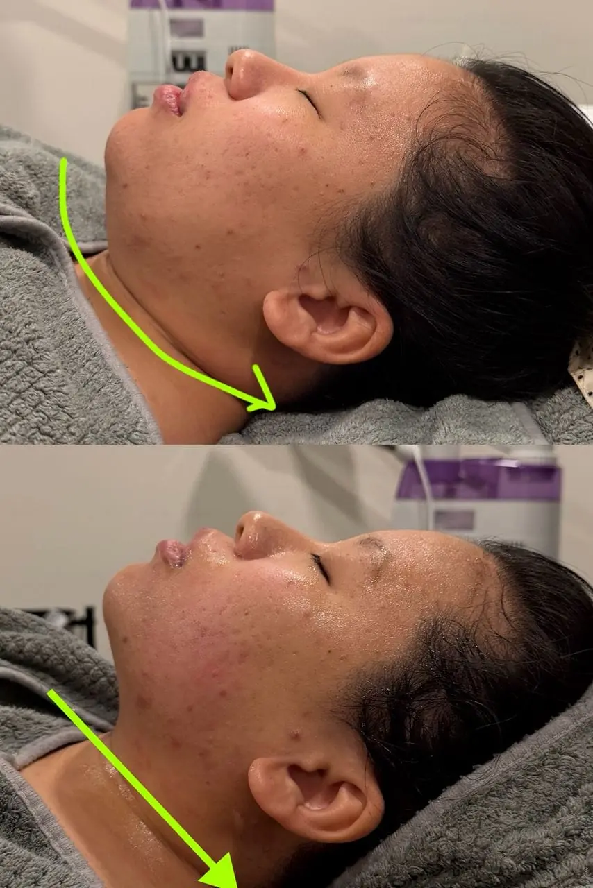 Titanium Ultrasound Lifting treatment example