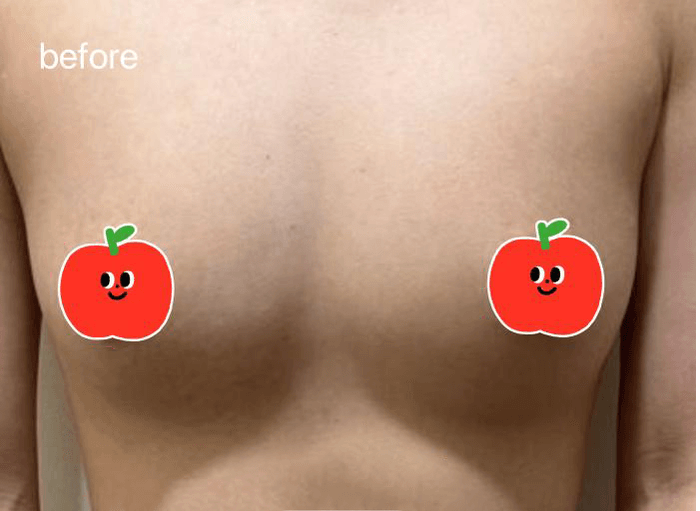 Breast Implant — Before & After 1 · The Valley, Kuala Lumpur