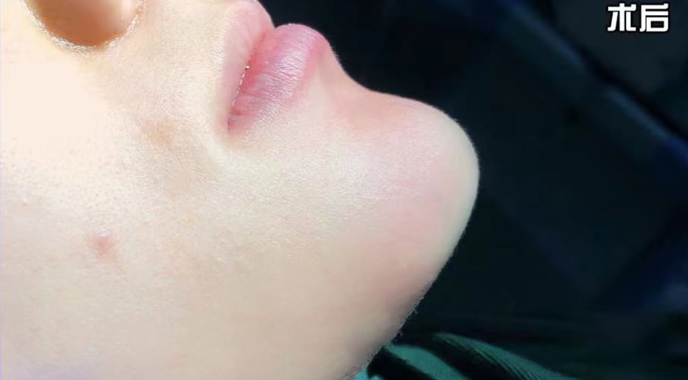 Chin Implant — Before & After 2 · The Valley, Kuala Lumpur