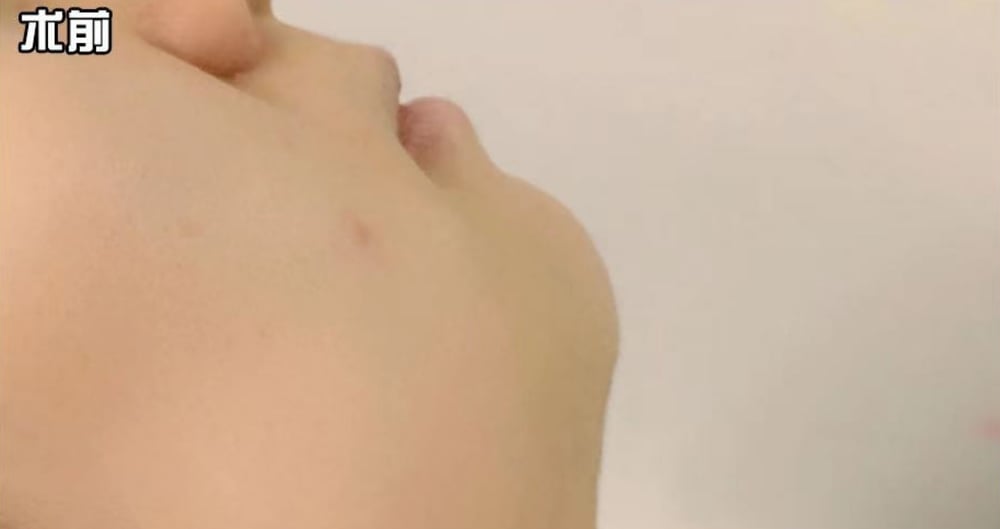 Chin Implant — Before & After 1 · The Valley, Kuala Lumpur