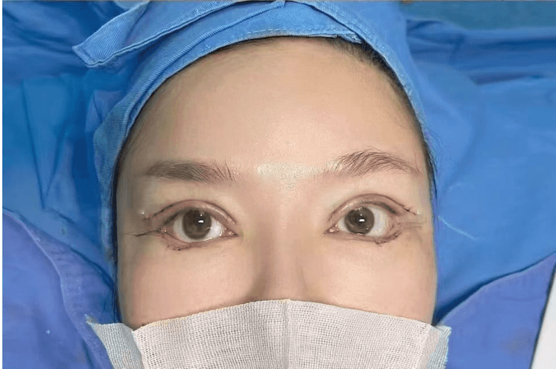 Eye Treatment — Before & After 2 · The Valley, Kuala Lumpur