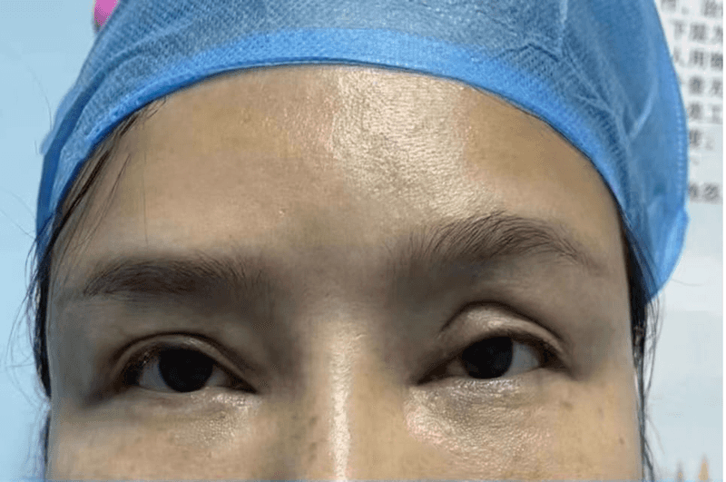 Eye Treatment — Before & After 1 · The Valley, Kuala Lumpur