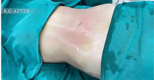 Liposuction — Before & After 2 · The Valley, Kuala Lumpur