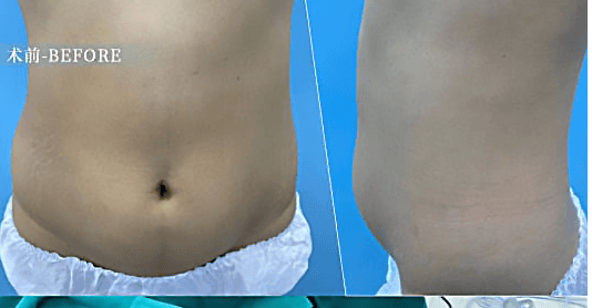 Liposuction — Before & After 1 · The Valley, Kuala Lumpur