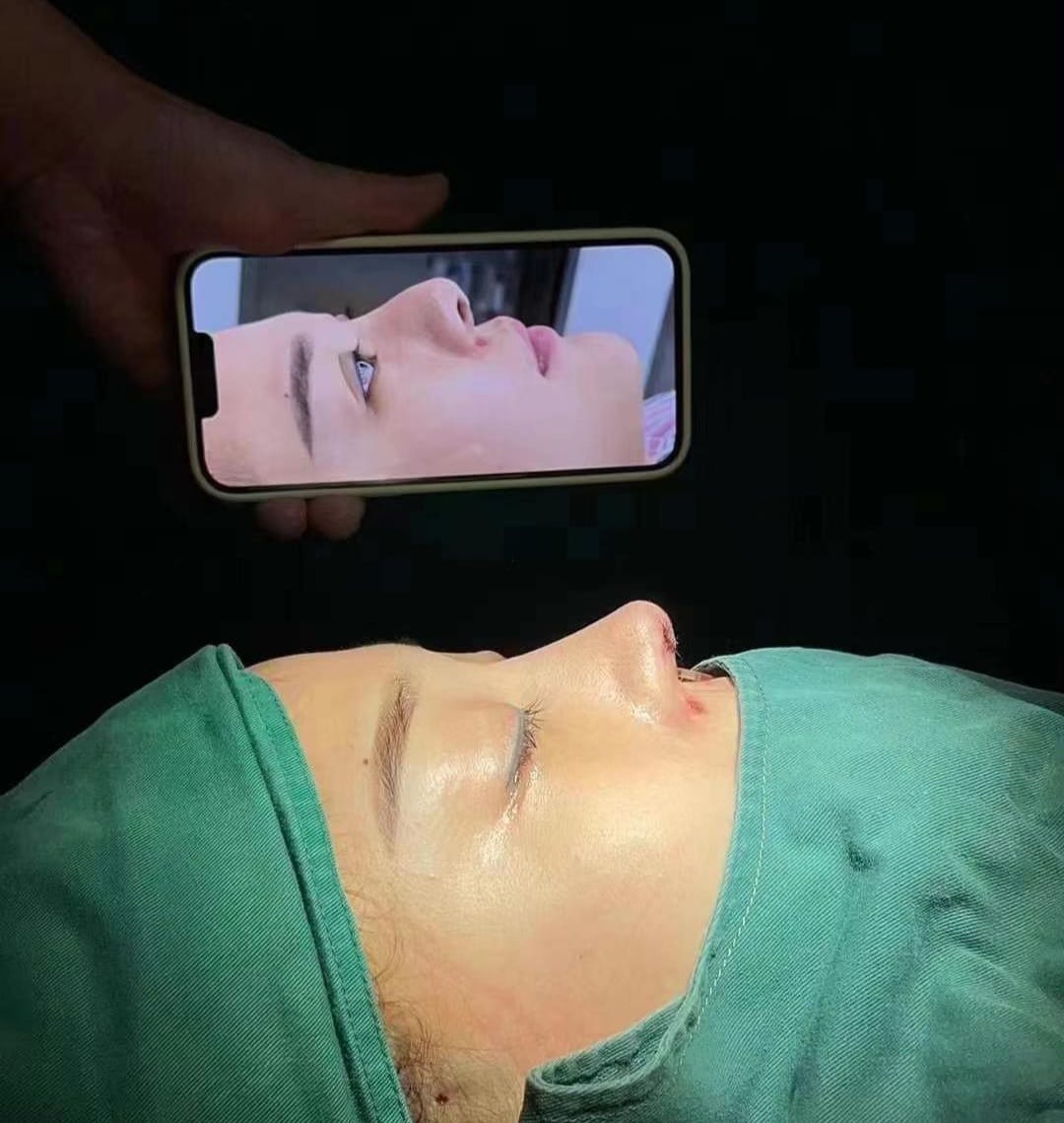 Rhinoplasty — Before & After 1 · The Valley, Kuala Lumpur